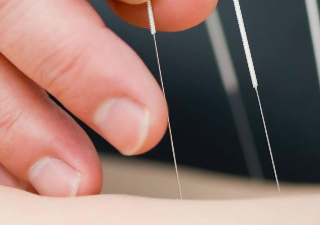 L'acupuncture